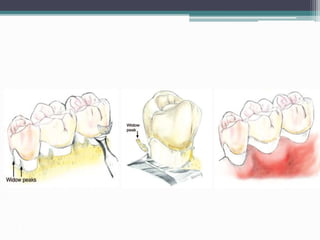 Management of palatal osseous defects
 