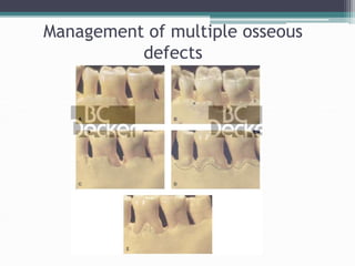 Management of furcation involvement
• Tunnel preparation
• Root resection
• Hemisection
 