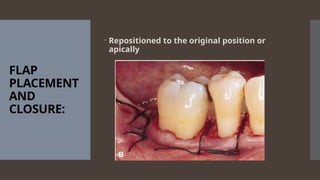 FLAP
PLACEMENT
AND
CLOSURE:
 Repositioned to the original position or
apically
 