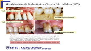 Hamp Classification RESECTIVE OSSEOUS SURGERY : Precision Reshaping for Periodontal Health ...