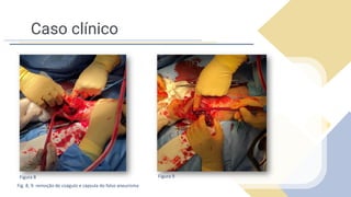 Caso clínico
Fig. 8, 9: remoção de coágulo e cápsula do falso aneurisma
Figura 8 Figura 9
 