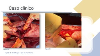 Caso clínico
Fig. 10, 11: identificação e rafia de arteriotomia
Figura 10 Figura 11
 