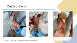 Caso clínico
Fig. 12, 13, 14 1º dia, 5º dia e 12º dia de pós-operatório respetivamente
Figura 12 Figura 13 Figura 14
 