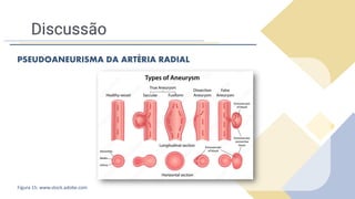 Discussão
PSEUDOANEURISMA DA ARTÉRIA RADIAL
Figura 15: www.stock.adobe.com
 
