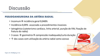 Discussão
• Incomum→ incidência geral 0,048%
• Incidência 0,09% associado a procedimentos invasivos
• Iatrogénico (cateterismo cardíaco, linha arterial, punção de FAV, fixação de
fratura do radio)
• 3 casos → gasimetria→ compressão inadequada/curta duração
• ↑ dos casos com utilização da artéria radial como acesso
PSEUDOANEURISMA DA ARTÉRIA RADIAL
Figura 16: Wolfgang, et al.
 