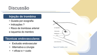 Discussão
• Guiada por ecografia
• Indicações ?
• Risco de trombose arterial
e isquemia do membro
Injeção de trombina
Figura 24: Franklin, et al.
Técnicas endovasculares
• Exclusão endovascular
• Alternativa a cirurgia
• < eficaz e > custo
 