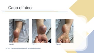 Caso clínico
Fig. 1, 2, 3: lesão na extremidade tenar do antebraço esquerdo
Figura 1 Figura 3
Figura 2
 
