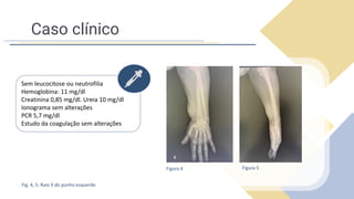 Caso clínico
Sem leucocitose ou neutrofilia
Hemoglobina: 11 mg/dl
Creatinina 0,85 mg/dl. Ureia 10 mg/dl
Ionograma sem alterações
PCR 5,7 mg/dl
Estudo da coagulação sem alterações
Fig. 4, 5: Raio X do punho esquerdo
Figura 4 Figura 5
 