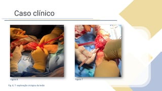 Caso clínico
Fig. 6, 7: exploração cirúrgica da lesão
Figura 6 Figura 7
 