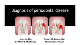 Diagnosis of periodontal disease
Supervised by:
Dr. Maher B. Muhammed
Prepared & Designed by:
Muhammed M. Nasser
 