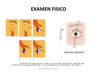 EXAMEN FISICO

Separador palpebral

URGENCIAS OFTALMOLOGICAS

 