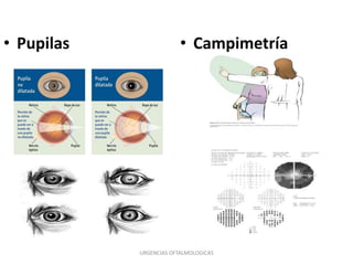 • Pupilas

• Campimetría

URGENCIAS OFTALMOLOGICAS

 