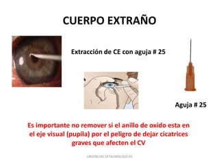 CUERPO EXTRAÑO
Extracción de CE con aguja # 25

Aguja # 25
Es importante no remover si el anillo de oxido esta en
el eje visual (pupila) por el peligro de dejar cicatrices
graves que afecten el CV
URGENCIAS OFTALMOLOGICAS

 