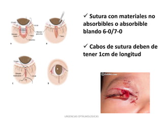  Sutura con materiales no
absorbibles o absorbible
blando 6-0/7-0
 Cabos de sutura deben de
tener 1cm de longitud

URGENCIAS OFTALMOLOGICAS

 