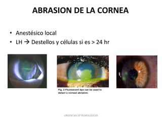 ABRASION DE LA CORNEA
• Anestésico local
• LH  Destellos y células si es > 24 hr

URGENCIAS OFTALMOLOGICAS

 