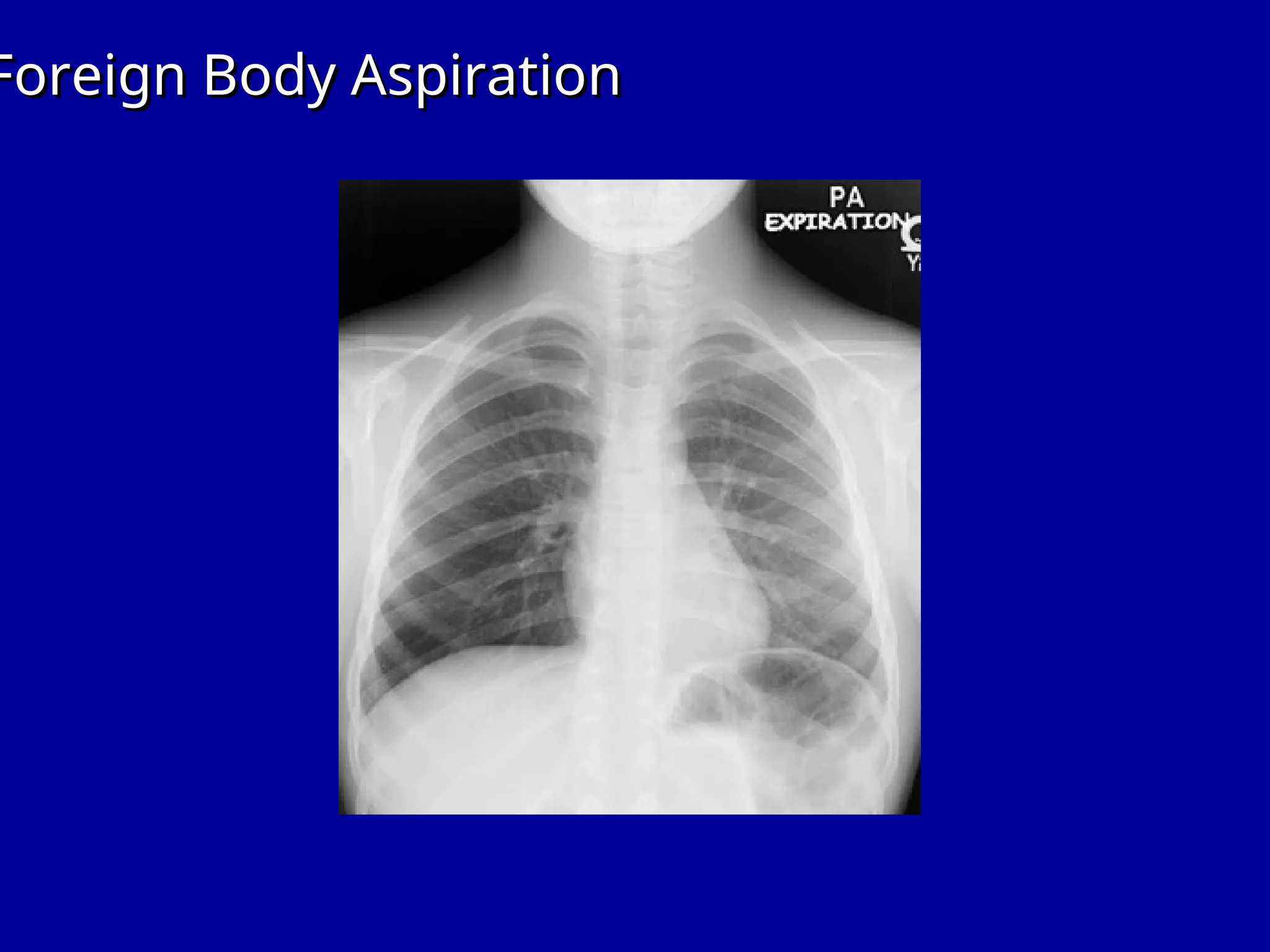 Foreign Body Aspiration
Foreign Body Aspiration
 