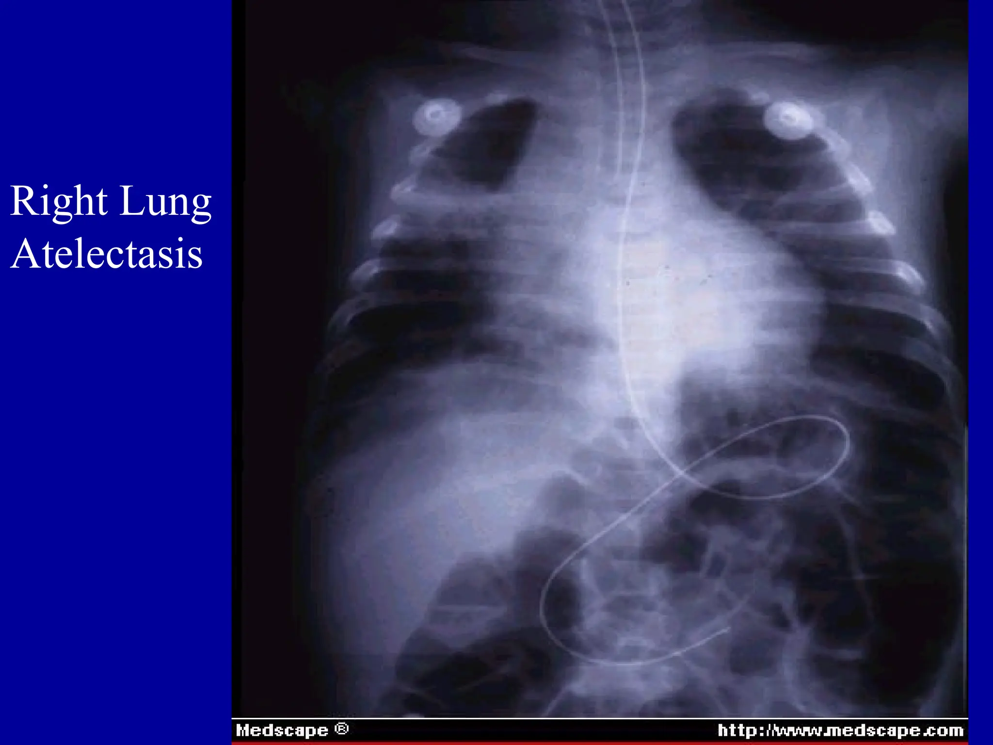 Right Lung
Atelectasis
 