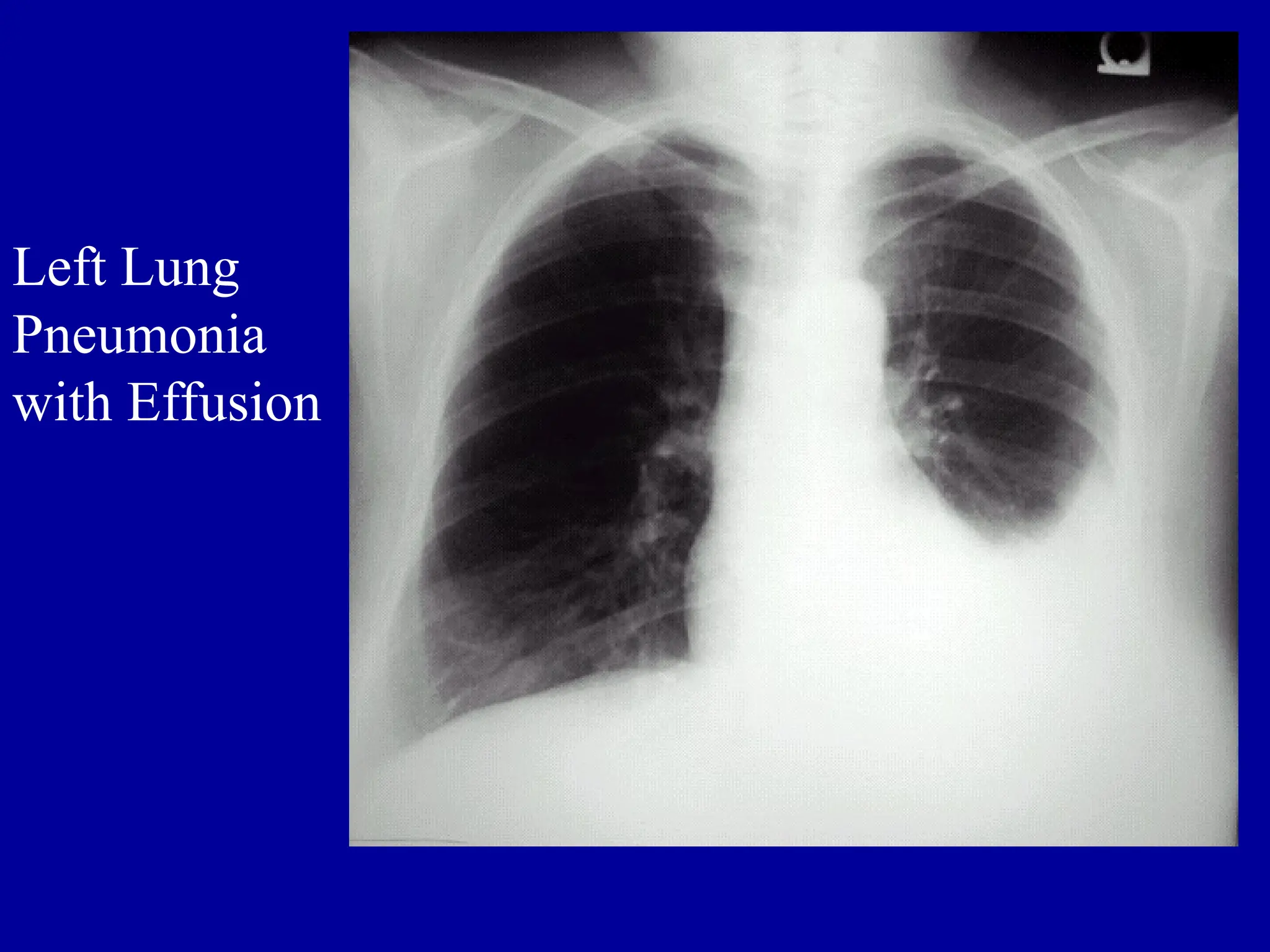 Left Lung
Pneumonia
with Effusion
 