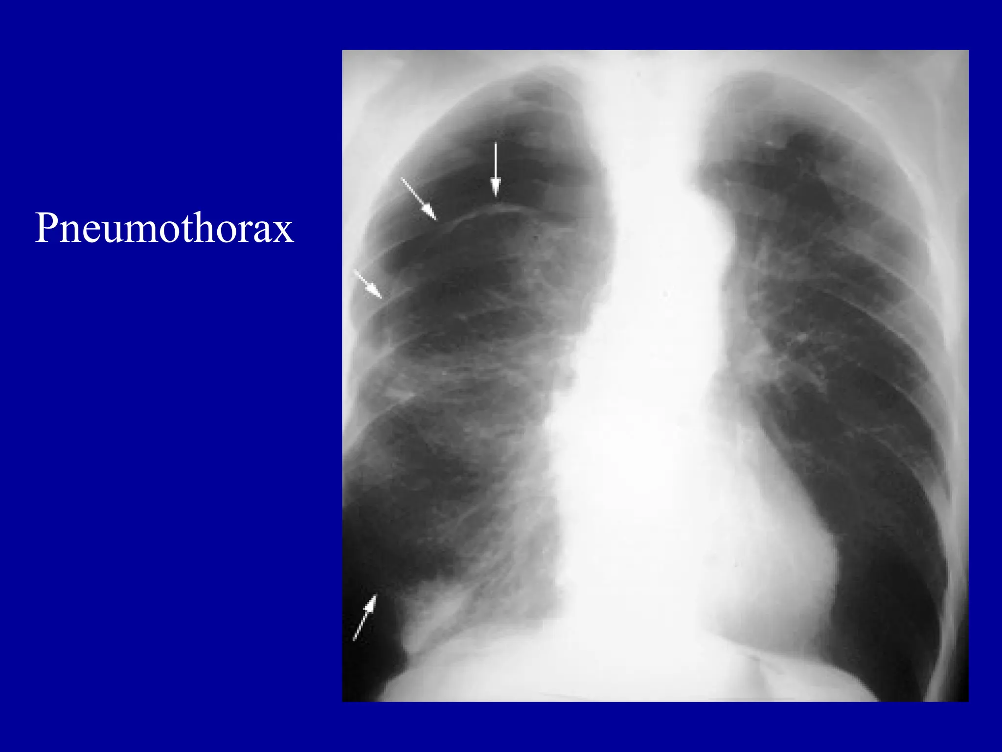 Pneumothorax
 