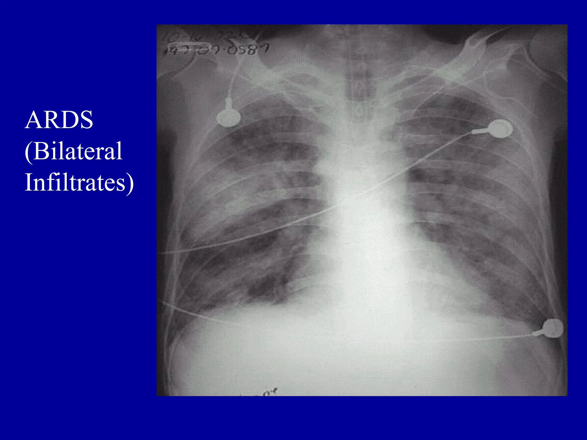 ARDS
(Bilateral
Infiltrates)
 