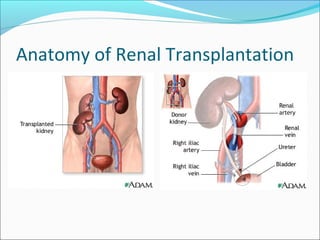 Anatomy of Renal Transplantation
 