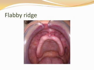 Flabby Ridge Radiograph Residual ridge reduction and flabby ridges | PPSX