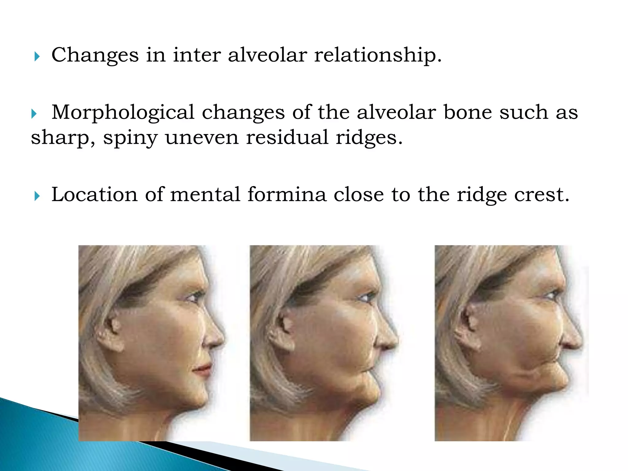 Residual ridge resorption | PPTX