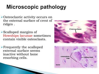 Osteoclastic activity occurs on
the external surface of crest of
ridges .
Scalloped margins of
Howships lacunae sometimes
contain visible osteoclasts.
Frequently the scalloped
external surface seems
inactive without bone
resorbing cells.
 