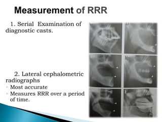 1. Serial Examination of
diagnostic casts.
2. Lateral cephalometric
radiographs
◦ Most accurate
◦ Measures RRR over a period
of time.
 