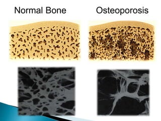 Normal Bone Osteoporosis
 