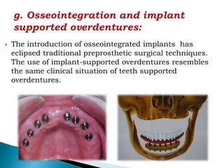  The introduction of osseointegrated implants has
eclipsed traditional preprosthetic surgical techniques.
The use of implant-supported overdentures resembles
the same clinical situation of teeth supported
overdentures.
 