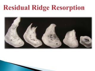 Residual ridge resorption