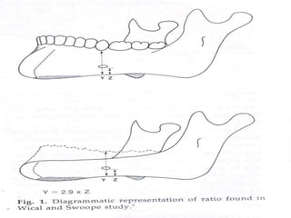 residual ridge resorption in cd patients | PPT