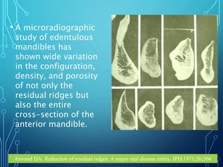 residual ridge resorption in cd patients | PPT