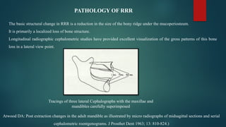 RESIDUAL RIDGE RESORPTION IN PROSTHODONTICS | PPTX