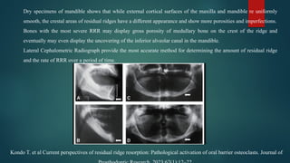 RESIDUAL RIDGE RESORPTION IN PROSTHODONTICS | PPTX