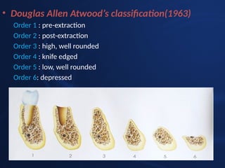 Comprehensive Overview and Management of Residual Ridge Resorption in ...