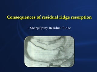 Sharp Spiny Ridge Comprehensive Overview and Management of Residual Ridge Resorption in ...