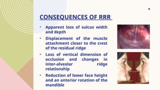 residual ridge resorptions seminar .pptx