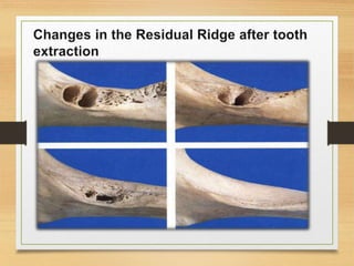 Recorving Ridges Residual ridge resorption | PPTX