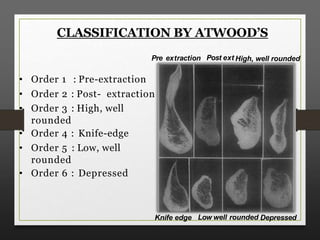Residual ridge resorption | PPTX