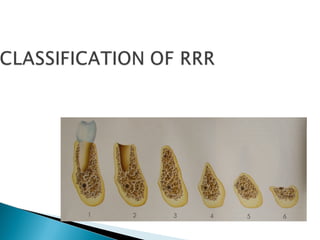 PROSTHODONTIC MANAGEMENT OF RESIDUAL RIDGE REDUCTION | PPT