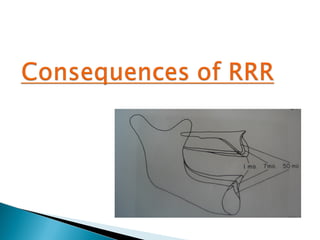 PROSTHODONTIC MANAGEMENT OF RESIDUAL RIDGE REDUCTION | PPT