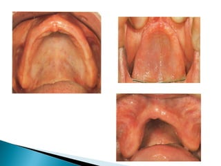 PROSTHODONTIC MANAGEMENT OF RESIDUAL RIDGE REDUCTION | PPT