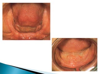 PROSTHODONTIC MANAGEMENT OF RESIDUAL RIDGE REDUCTION | PPT