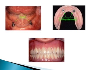 PROSTHODONTIC MANAGEMENT OF RESIDUAL RIDGE REDUCTION | PPT