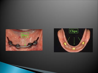 PROSTHODONTIC MANAGEMENT OF RESIDUAL RIDGE REDUCTION | PPT