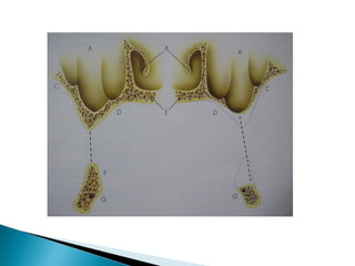 PROSTHODONTIC MANAGEMENT OF RESIDUAL RIDGE REDUCTION | PPT