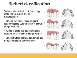 residual ridge resorption seminar final [Autosaved] latest.ppt