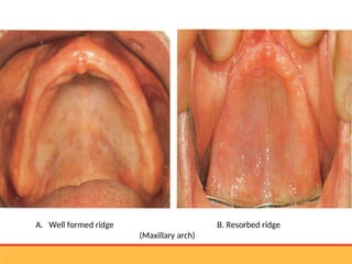 residual ridge resorption seminar final [Autosaved] latest.ppt